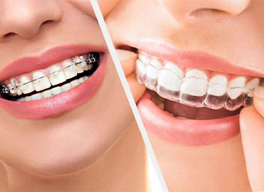 Braces Treatment in India