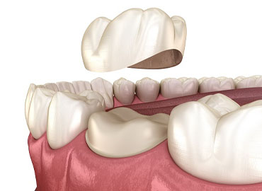Dental Crown Treatment in India