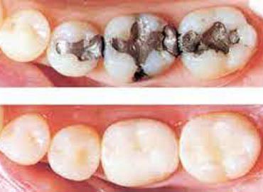 Dental Implant Services in India