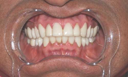 Dental Crown Treatment in India