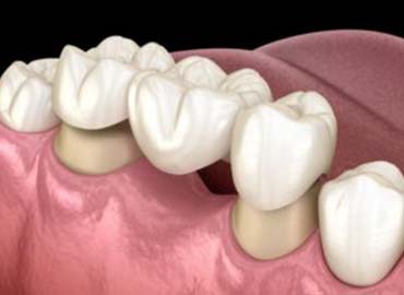 Smile Makeover Treatment in India